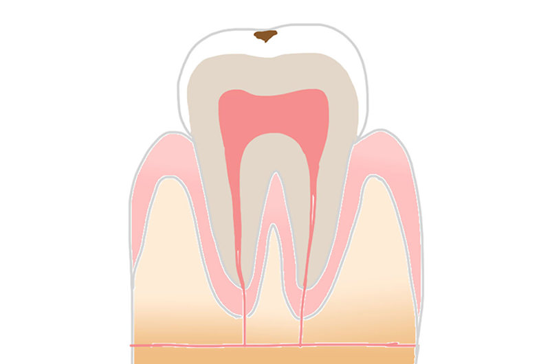 エナメル質の虫歯「C1」