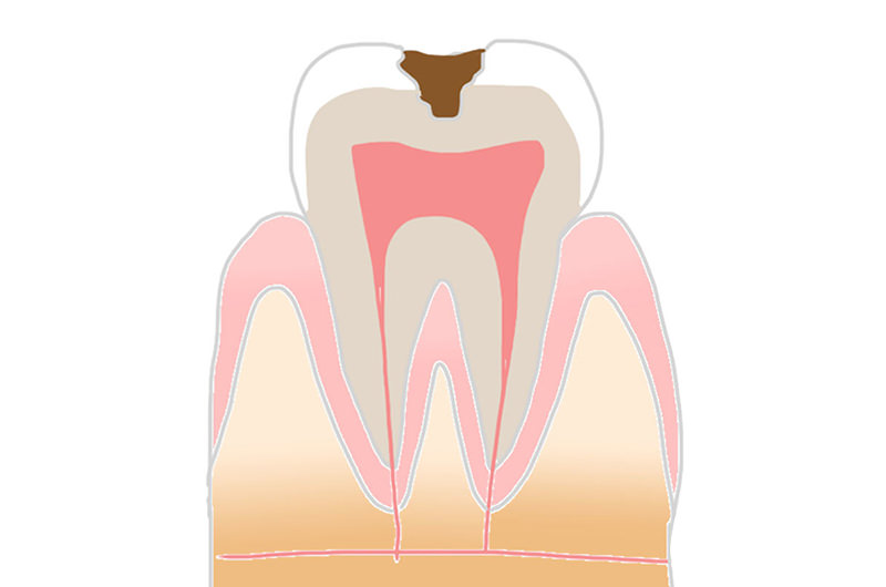 象牙質の虫歯「C2」