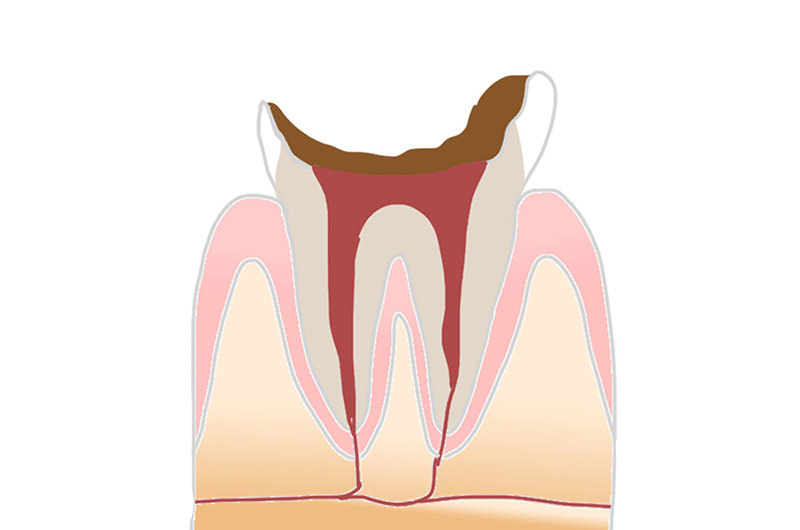 虫歯によって歯が崩壊した状態「C4」